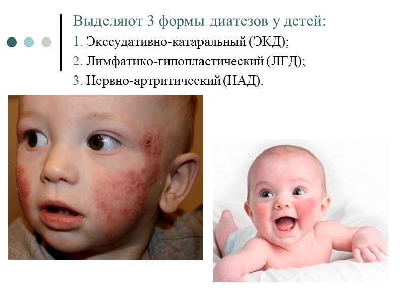 Выделяют 3 формы диатезов у детей: 1. Экссудативно-катаральный (ЭКД); 2. Лимфатико-гипопластический (ЛГД); 3. Нервно-артритический